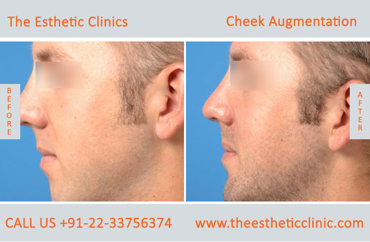 Cheek Augmentation, Cheek Implants surgery before after photos in mumbai india (2)
